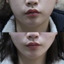 구월한의원 | [인천 실리프팅] 구월동 한의원 실리프팅 직후,2주후기