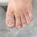 문제성 손, 발 오감네일 이미지