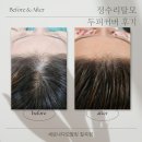 출산 후 정수리 헤어라인 탈모 SMP 두피 커버 후기 새로나다모발킹 칠곡점