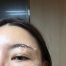 기대만족부산 - 강남구 학동로43길 38 | 부산점제거 만족 후기 점빼기 잘하는곳 다녀온 내돈내산 경과후기
