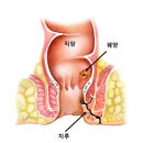 [항상쾌한외과] 22살 여대생의 치루 수술 후기 (공감주의☆)