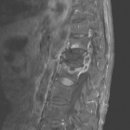 결핵성 골수염(Tuberculous osteomyelitis) 이미지