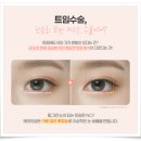 뒤트임 밑트임 비용 각각 얼마? 수술 방법의 차이점과 붓기 흐름 후기 궁금해요