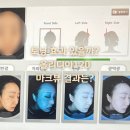 부천블라썸의원 | 올리디아120 스킨부스터 후기｜효과 언제부터? 붓기...토닝 5회 + 레이저 3회 + 점 제거｜부천 블라썸의원)