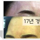 더블류성형외과 네이버블로그