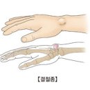 결절종(Ganglion) 근골격질환이란? 이미지