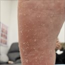 동묘앞 창신역 발각질제거 콤플렉스 해결 리오풋케어 내성발톱 무좀발톱 발각질 네일 문제성발