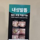채플린통증교정클리닉 | 수원역 내성발톱 교정, 회차별로 이렇게 달라졌어요 (수원위편한내과 손발톱클리닉 후기 2편)