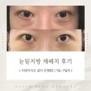 하얀멍이 | 내돈내산 눈밑지방 재배치 + 지방이식 후기 (1일~7일차)