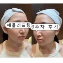 올채 | 한남동피부과 추천 채올리프팅 모공 개선 및 콜라겐 재생 후기