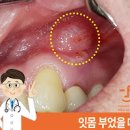 잇몸 부었을때 잇몸염증 치은염 치주염 치수염 원인 이미지