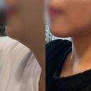 서울준신경외과의원 | 신상성형외과 이중턱 지방흡입 3주차 후기 :: 실밥제거 후 바본, 턱라인 경과 내돈내산 기록(2편)