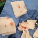 자연과 콩 | 양쪽눈 콩다래끼 제거 수술 후기(자연치유X)