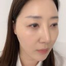 대구피부미용 아르유에스테틱 10년이상 경력 금손원장님 페이스리프팅 후기