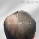 에이원헤어라인 이미지