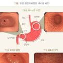 미란성위염 증상 원인 표재성위염 차이점 이미지
