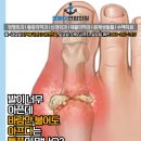 대구연합정형외과의원 | 반월당역/중앙로역/명덕역/대구/중구/뽀빠이연합의원/정형외과/신경외과/통증의학과/통풍/발가락통증)