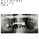 뼈이식을 통한 앞니, 어금니 임플란트 사례 이미지