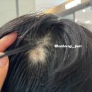 탈모앰플 뮤리나 원형탈모 잡고 머리숱관리 집에서 관리하는 방법