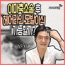 이마축소술 흉터 위 모발이식 가능할까? (쿠키영상 포함) 이미지