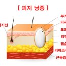 장미꽃과 나이팅게일 피부과의원 | [수원 장미꽃과 나이팅게일외과의원] 뒤통수 표피낭 제거 수술 생생후기,한달후 후기 및 보험처리 후기