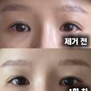 동아프라자아케이드 | 안양 범계 아이라인 눈썹문신 잔흔제거 통증 붓기 비용 후기