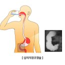 십이지장조영술 이미지