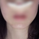 보보약국 | 공시생의 코수술 일기, 코찔찔이 다람쥐가 돼(3일차)