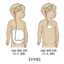 수두증[hydrocephalus] 이미지