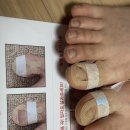 엄지 | 핀처 내성발톱교정기 후기｜엄지발가락 통증, 집에서 해결해본 기록