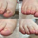 역대급 무좀발톱, 시원하게 제거 (사진 O) 통증까지 한번에 해결🙆🏻‍♀