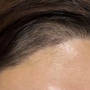 M.하얀집 | 여자 3600모 헤어라인 절개 모발이식 5개월 후기 암흑기 m자탈모 모발이식 생착률 내돈내산 비용