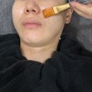써니1 | [강남] 압구정피부과 안아픈 리프팅레이저 써니레이저 1회 후기