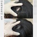 (주)마음에점을찍다 | 광주두피문신 마음에점을찍다 본점 실력있는 두피문신 전문샵 흉터 커버 후기