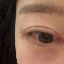 이상필 | 대구 아이라이너 문신제거 내돈내산 솔직후기