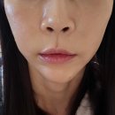 멍스타 | 입술필러 멍 붓기 이물감 후기 ft. 구월동피부과