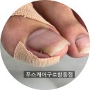 와이제이프라자 | 광명 사거리 발톱 통증으로 가만히 있어도 욱신하다면? 푸스 케어 구로항동점에서 해결한 후기
