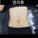 완산-66 | “55도 66도 아닌 그 애매함｜날씬해도 고민은 복부입니다” 전주 오은에스테틱