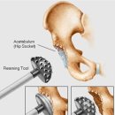 고관절통증 고관절통증의 원인과 치료법 이미지