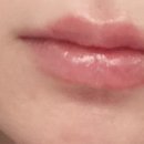 어린공주성형외과의원 | 어린공주의원에서 입술 필러 맞은 후기