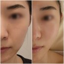 아나 피부샵 | 서초 교대 피부관리 아나티크에스테틱 B관리 비대칭 얼굴라인 개선 후기
