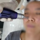 레이져 | 광양피부샵 &#34;나예뻐&#34; 광양 최초 트라이엄레이져후기