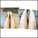 청담밴스의원 | 압구정제모 젠틀맥스프로플러스 2회차 청담밴스의원