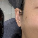 강릉세탁 | 강릉 밴스의원 잡티제거 세르프 리프팅 내돈내산 상세 후기