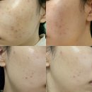 비리야에스테틱 | (후기) 다산피부관리/ 비리야에스테틱 스케일링&압출