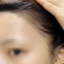 올라헤어 - 성북구 | M자 헤어라인 고민 끝, 성수동 올라뷰티 헤어라인 채움 내돈내산 후기ㅣ지인소개 페이백 가능