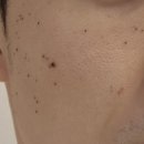 리샘한의원 | 리샘한의원 압구정점 편평사마귀 쥐젖 무한제거 내돈내산 후기(+리터치)