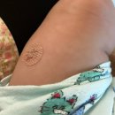 동탄아이언소아청소년과의원 | [후기] 4개월 예방접종 - 접종열, 붓기, 보챔, 분태기