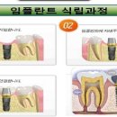 오스템임플란트--급락후 방향은?급하신분 필독 이미지