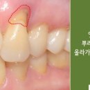 CCL치과 네이버블로그